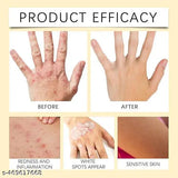 Vitiligo Bee Venom Treatment Cream (Pack of 1)