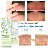 Eczemaron for Ringworm, Itching, Eczema & Fungal Infection Antifungal Cream (Pack of 2)
