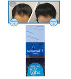 Austro Labs Minoxal Solution for Hair Growth (Pack of 1 - 60ml)