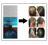 Austro Labs Minoxal Solution for Hair Growth (Pack of 1 - 60ml)