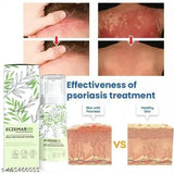 Eczemaron for Ringworm, itching, Eczema & Fungal Infection Anti Fungal Cream | (pack of 1)